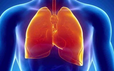 Talc Pleurodesis: Randomized Trials on Lung Inflammation