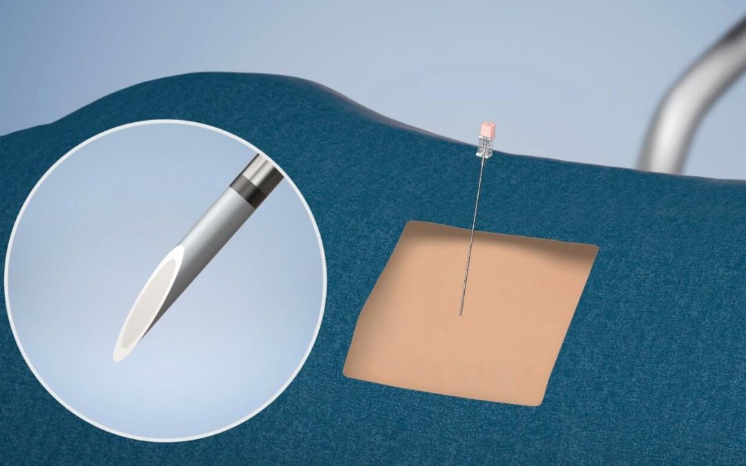 Ultrasound-guided pigtail for pleural effusion